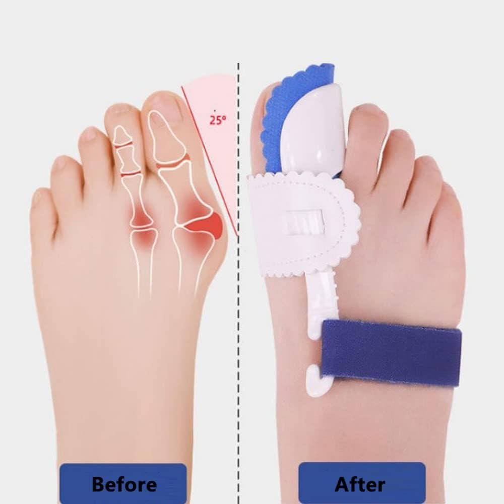 Foot Orthotic Bunion Splint Crooked  Thumb Corrector (1 Pair)